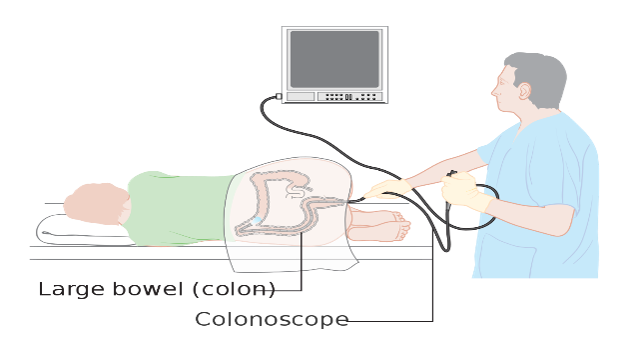 colonoscopy.png