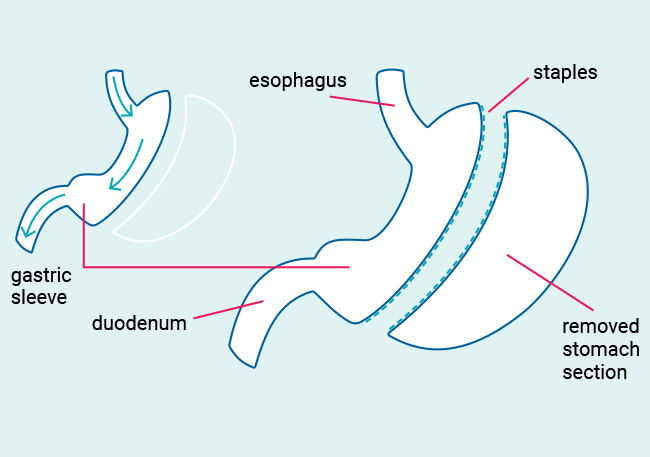 Sleeve Gastrectomy.jpg