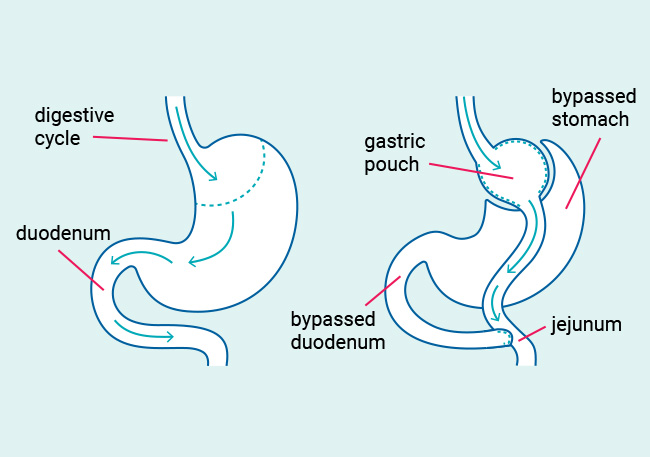 Roux-en-Y Gastric Bypass.jpg